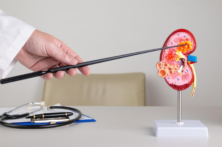 Kidney Cancer