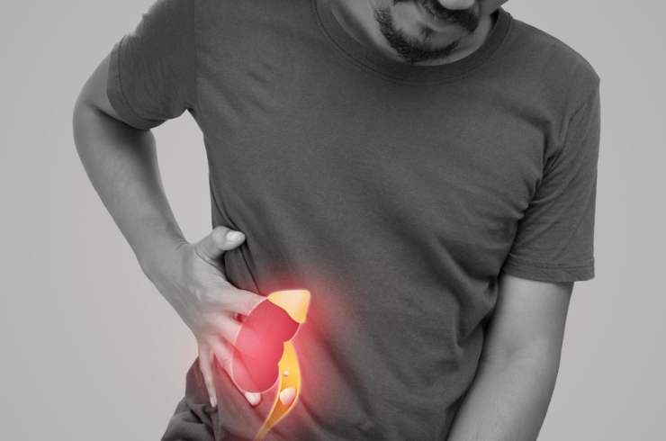 Kidney Stones