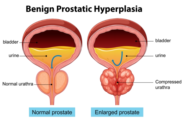 Benign Prostatic Hyperplasia